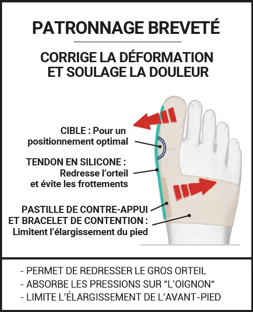 correction avec et sans orthèse hallux valgus EPITACT